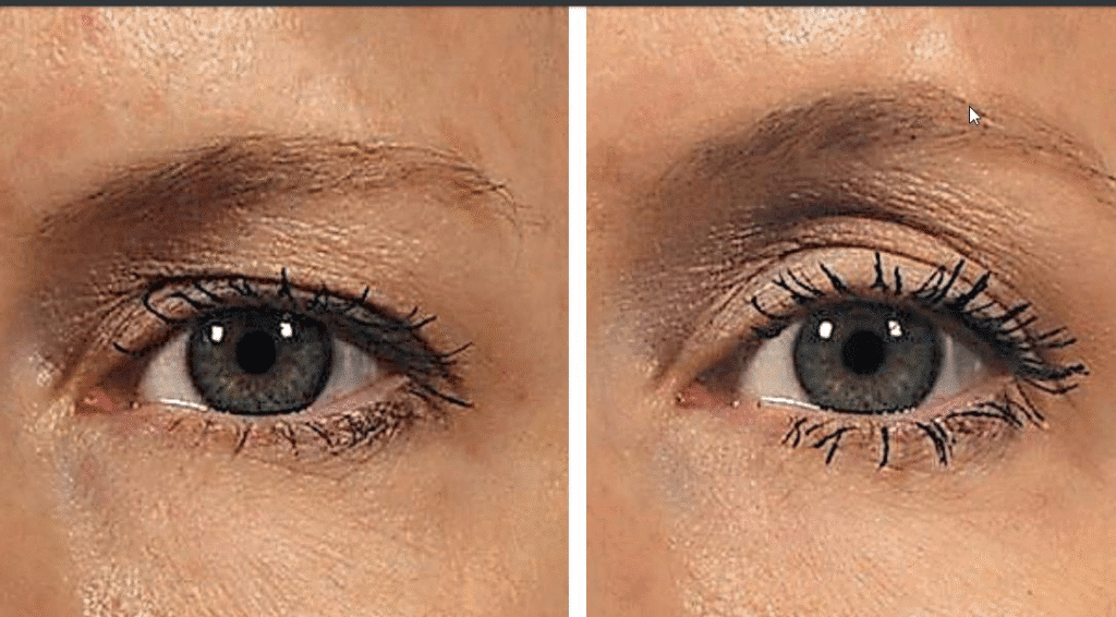 Ultherapy for Eyes